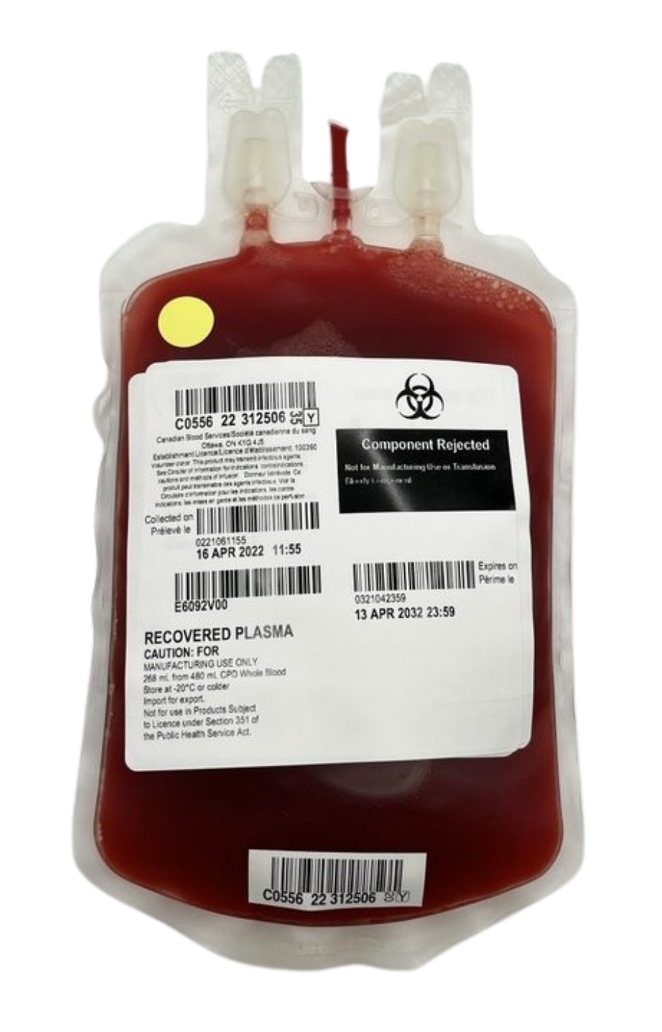 A unit of plasma viewed from the front that is unusually dark red in colour due to RBC contamination. 