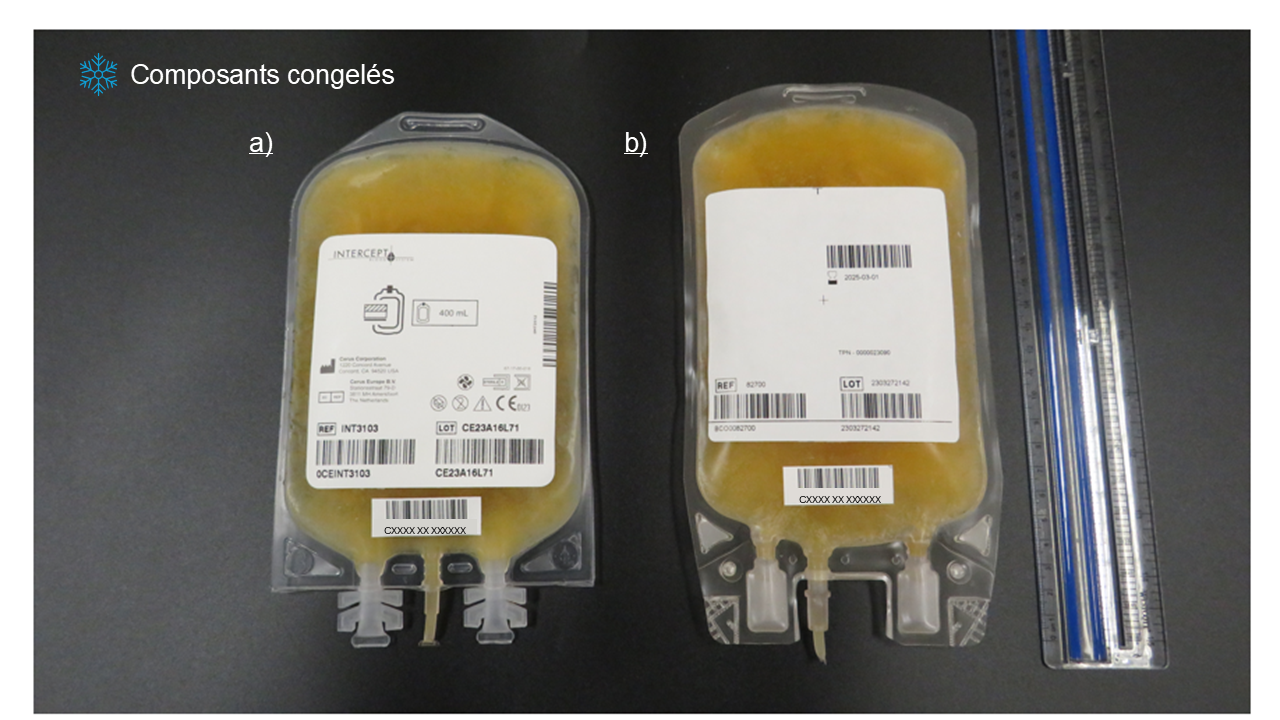 Comparaison entre le plasma-aphérèse congelé traité au psoralène et le plasma-aphérèse non traité lorsque les deux composants sont congelés. a) Plasma-aphérèse congelé traité au psoralène; b) Plasma-aphérèse.