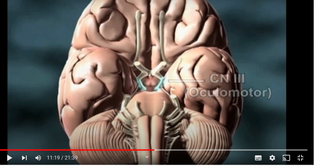 a screen shot from an instructional video about organ donation and neurological determination of death showing an image of a brain