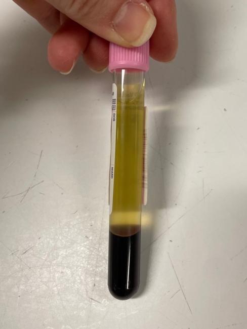 A small tube with dark red blood cells at the bottom and light yellow liquid above. 