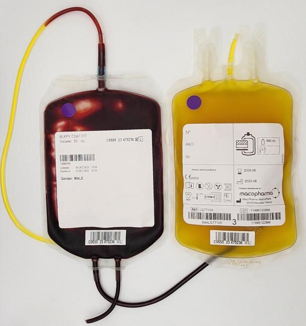 Two units lay on a white surface side by side; the dark red buffy coat unit is on the left and a yellow liquid is in the unit on the right.  