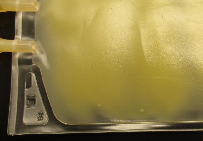 A close up view of a platelet unit with small white dots near the edge of the bag. 