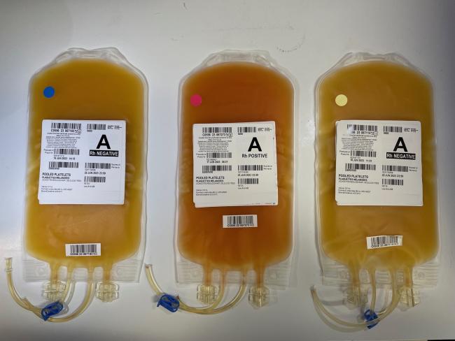 Three units of pooled platelets side-by-side. The centre unit is tinged red compared to the units on either side. 