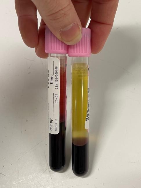 Two tubes side-by-side; the tube on the left has dark red blood cells at the bottom with pink liquid above while the tube on the right has dark red blood cells at the bottom with layers of light yellow liquid above. 